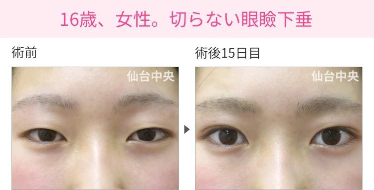 16歳、女性。切らない眼瞼下垂 症例写真1