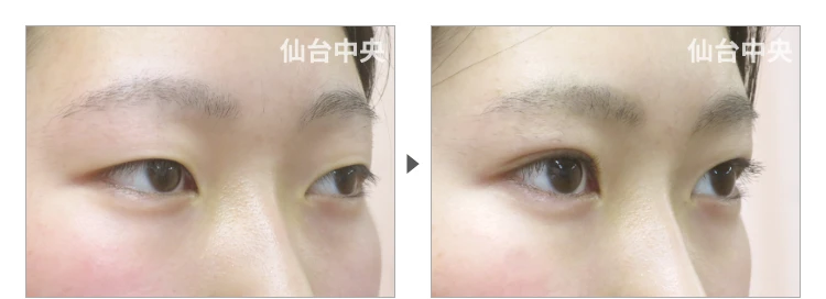 16歳、女性。切らない眼瞼下垂 症例写真2