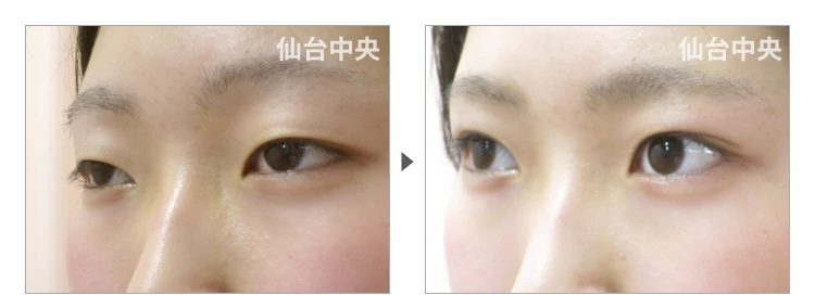 16歳、女性。切らない眼瞼下垂 症例写真3