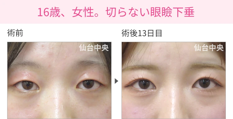 16歳、女性。切らない眼瞼下垂 症例写真1