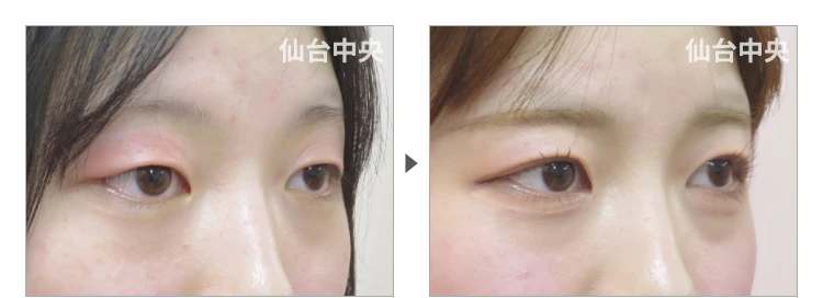 16歳、女性。切らない眼瞼下垂 症例写真2