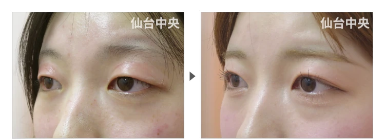 16歳、女性。切らない眼瞼下垂 症例写真3