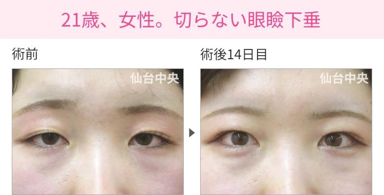 21歳、女性。切らない眼瞼下垂 症例写真1