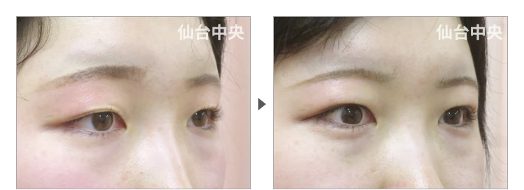 21歳、女性。切らない眼瞼下垂 症例写真2