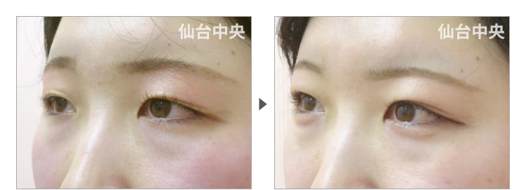 21歳、女性。切らない眼瞼下垂 症例写真3