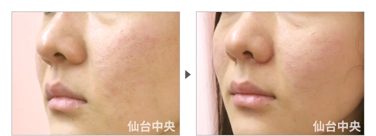 29歳、女性。小鼻縮小 症例写真4