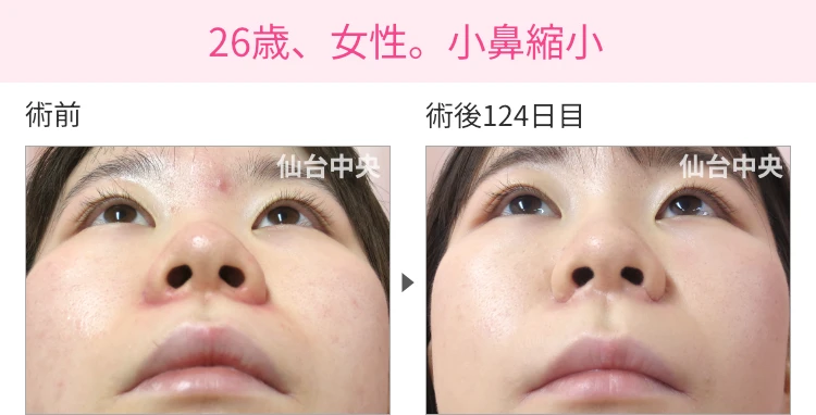 26歳、女性。小鼻縮小 症例写真1