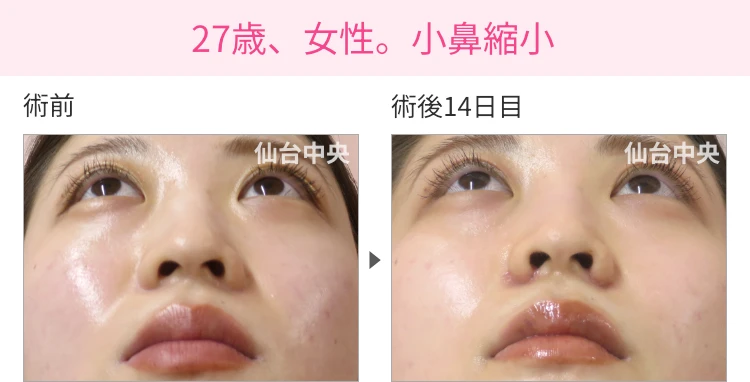 27歳、女性。小鼻縮小 症例写真1