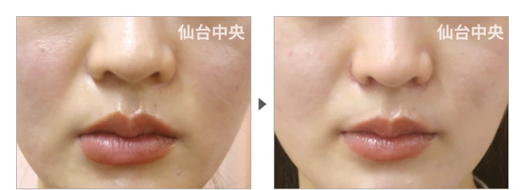 27歳、女性。小鼻縮小 症例写真2
