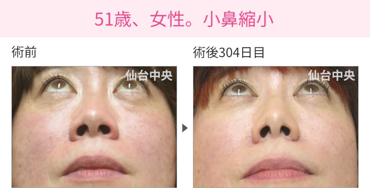 51歳、女性。小鼻縮小 症例写真1