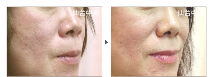 51歳、女性。小鼻縮小 症例写真3