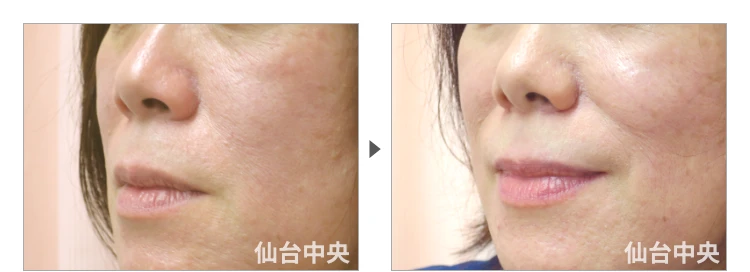 51歳、女性。小鼻縮小 症例写真4