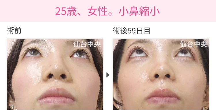 25歳、女性。小鼻縮小 症例写真1