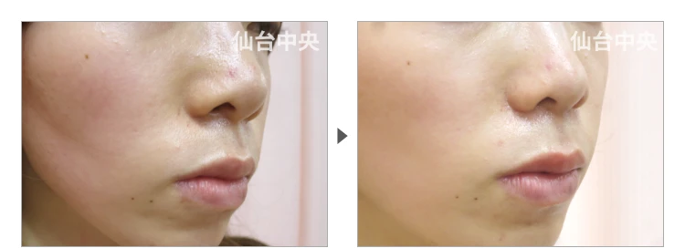 25歳、女性。小鼻縮小 症例写真3