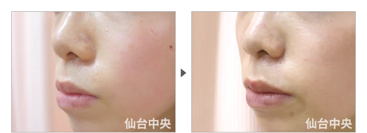 25歳、女性。小鼻縮小 症例写真4