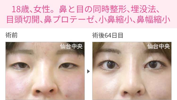 18歳、女性。鼻と目の同時整形、埋没法、目頭切開、鼻プロテーゼ、小鼻縮小、鼻幅縮小 症例写真1