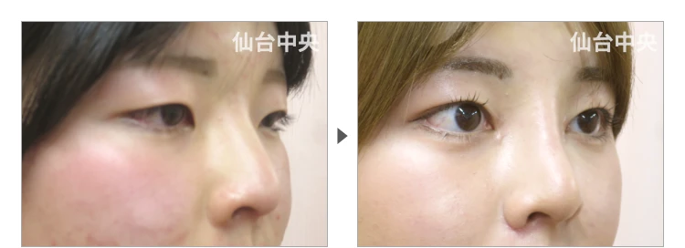 18歳、女性。鼻と目の同時整形、埋没法、目頭切開、鼻プロテーゼ、小鼻縮小、鼻幅縮小 症例写真2