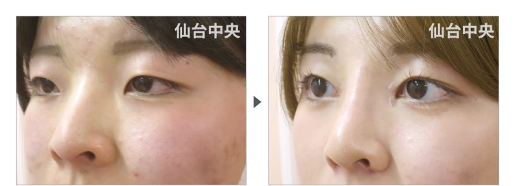 18歳、女性。鼻と目の同時整形、埋没法、目頭切開、鼻プロテーゼ、小鼻縮小、鼻幅縮小 症例写真3