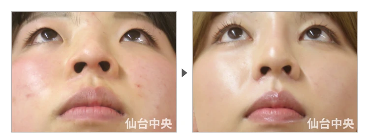 18歳、女性。鼻と目の同時整形、埋没法、目頭切開、鼻プロテーゼ、小鼻縮小、鼻幅縮小 症例写真4