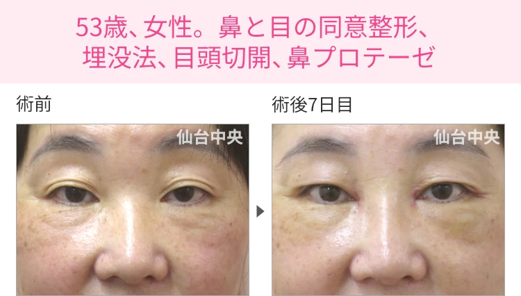 53歳、女性。鼻と目の同意整形、埋没法、目頭切開、鼻プロテーゼ 症例写真1