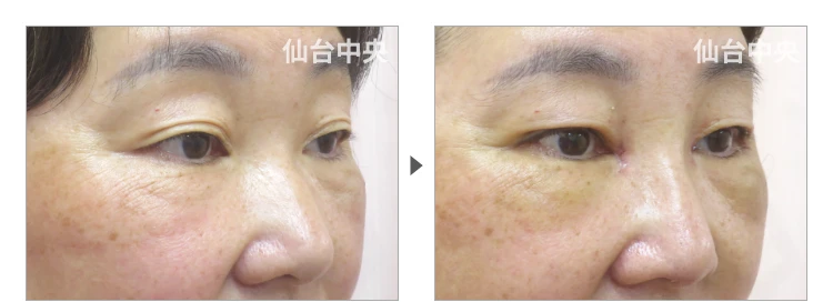 53歳、女性。鼻と目の同意整形、埋没法、目頭切開、鼻プロテーゼ 症例写真2