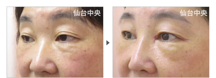 53歳、女性。鼻と目の同意整形、埋没法、目頭切開、鼻プロテーゼ 症例写真3