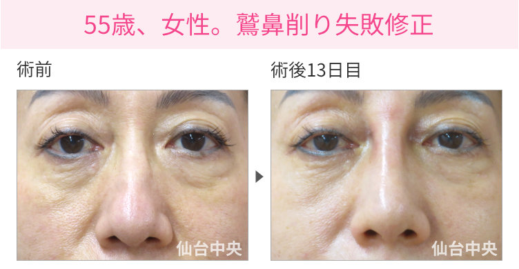 他院で行った鷲鼻削り手術への修正手術経過写真。術前と術後13日目（50代女性） - 仙台中央クリニック 症例写真1