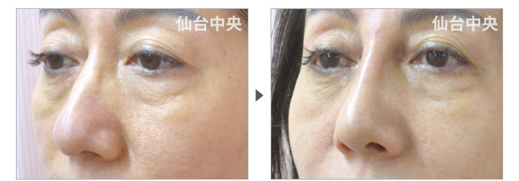 他院で行った鷲鼻削り手術への修正手術経過写真。術前と術後13日目（50代女性） - 仙台中央クリニック 症例写真3