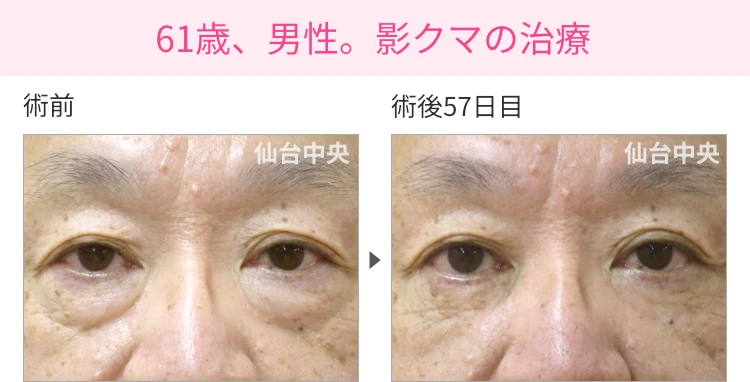 61歳、男性。影クマの治療 症例写真1