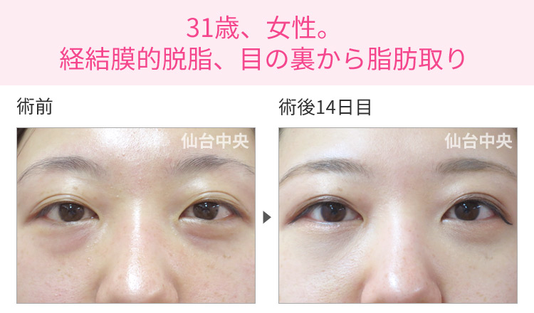 31歳、女性。経結膜的脱脂、目の裏から脂肪取り 症例写真1