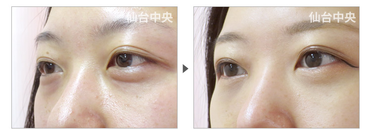 31歳、女性。経結膜的脱脂、目の裏から脂肪取り 症例写真3