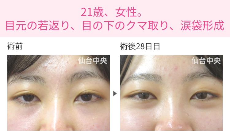 21歳、女性。目元の若返り、目の下のクマ取り、涙袋形成の症例写真 症例写真1