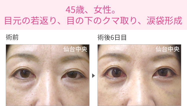 45歳、女性。目元の若返り、目の下のクマ取り、涙袋形成の症例写真 症例写真1