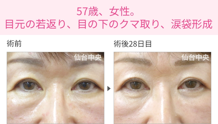 57歳、女性。目元の若返り、目の下のクマ取り、涙袋形成の症例写真 症例写真1