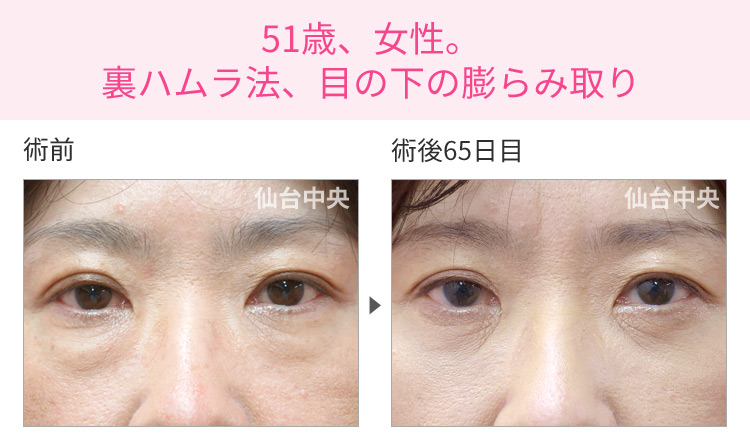 51歳、女性。裏ハムラ法、目の下の膨らみ取り 症例写真1
