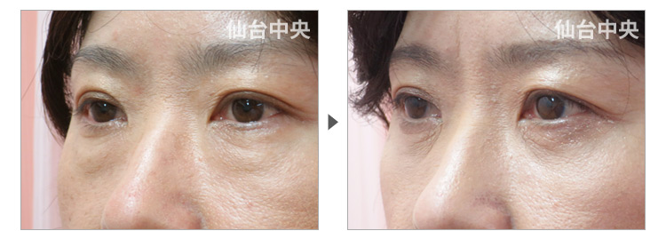 51歳、女性。裏ハムラ法、目の下の膨らみ取り 症例写真3