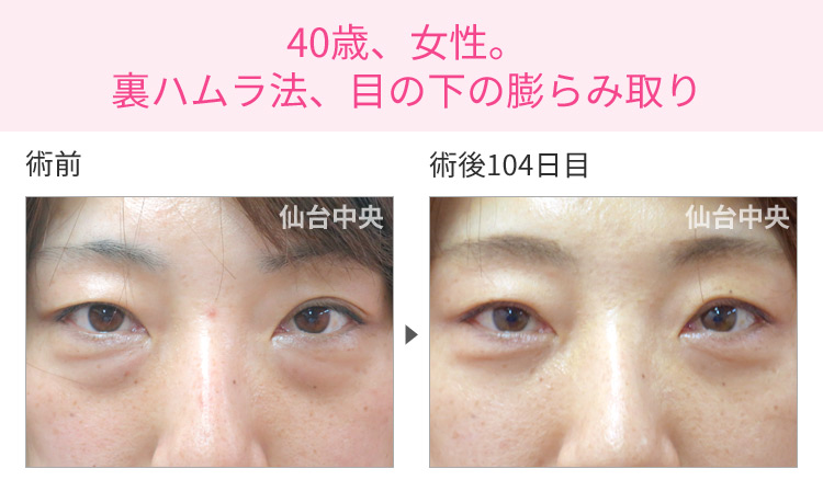 40歳、女性。裏ハムラ法、目の下の膨らみ取り 症例写真1