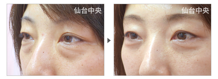 40歳、女性。裏ハムラ法、目の下の膨らみ取り 症例写真2