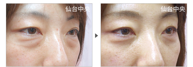 40歳、女性。裏ハムラ法、目の下の膨らみ取り 症例写真3