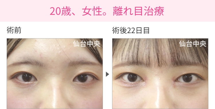 20歳、女性。離れ目治療 症例写真 症例写真1