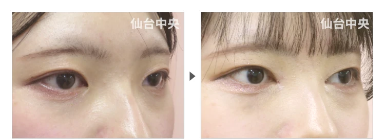 20歳、女性。離れ目治療 症例写真 症例写真2