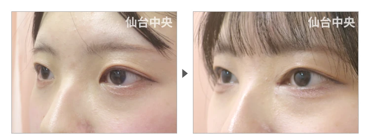 20歳、女性。離れ目治療 症例写真 症例写真3