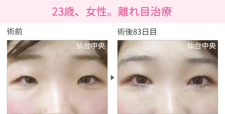 23歳、女性。離れ目治療 症例写真 症例写真1