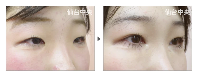 23歳、女性。離れ目治療 症例写真 症例写真2
