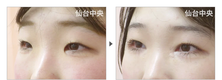 23歳、女性。離れ目治療 症例写真 症例写真3