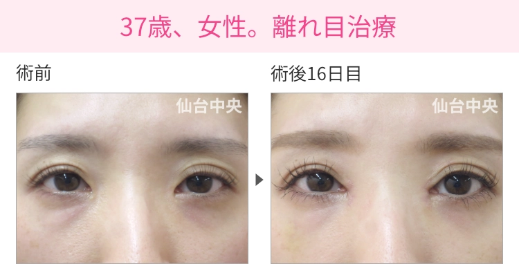37歳、女性。離れ目治療 症例写真 症例写真1