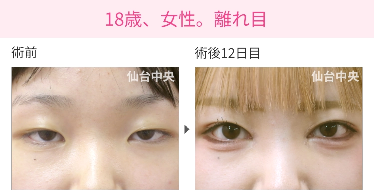 18歳、女性。離れ目 症例写真 症例写真1