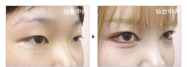 18歳、女性。離れ目 症例写真 症例写真2
