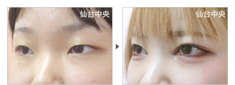 18歳、女性。離れ目 症例写真 症例写真3