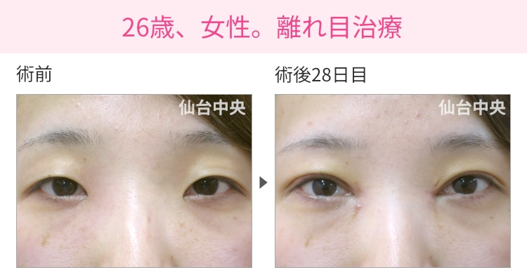 26歳、女性。離れ目治療 症例写真 症例写真1